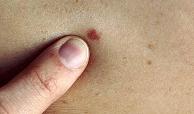 Vücudunuzda bu belirtiler varsa doktora başvurun